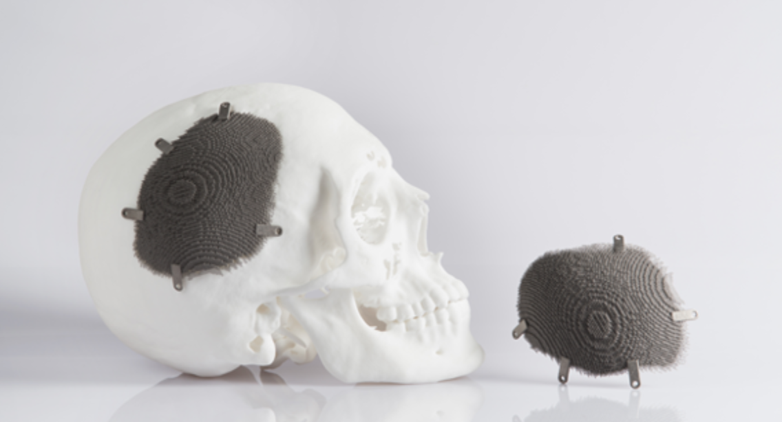 A revolutionary 3D printing part can help the skull in a variety of manners.